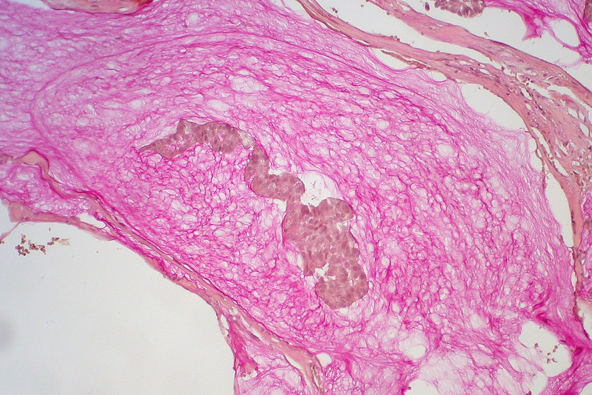 Byl objeven protein, který přispívá k rozvoji agresivnějšího karcinomu prsu, a probíhá výzkum zaměřený na nalezení způsobu, jak jej blokovat.