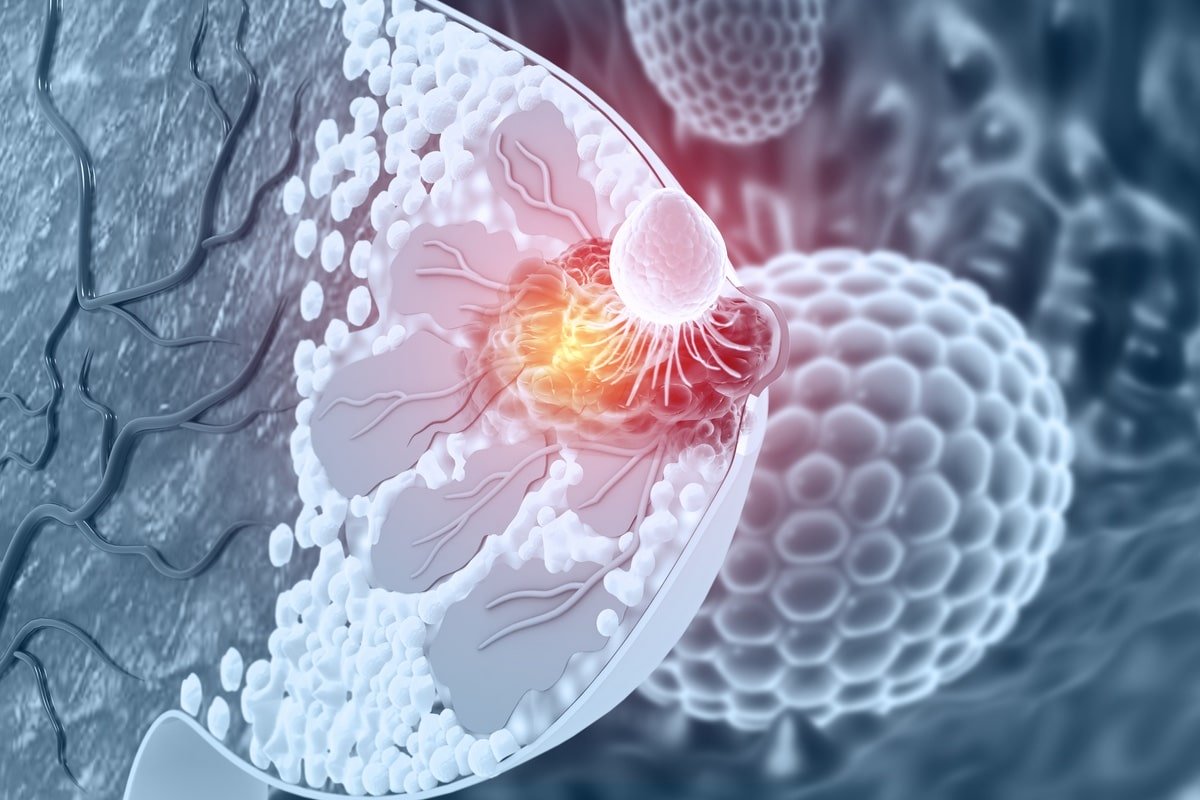 Byl objeven protein, který přispívá k rozvoji agresivnějšího karcinomu prsu, a probíhá výzkum zaměřený na nalezení způsobu, jak jej blokovat.